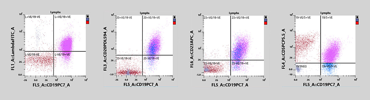 Fig. 3 Gráficos de dispersão de lambda, CD19, CD5, CD20 e CD23 do XF-1600, que mostram uma proliferação monoclonal anormal de células B com imunoglobulinas lambda (roxas).