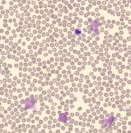 Fig. 2 Imagem digital (obtida pelo DI-60) a revelar manchas de Gumprecht (smudge cells).